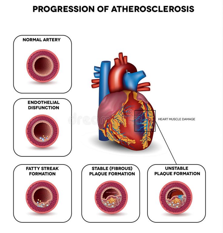 Atherosclerosis