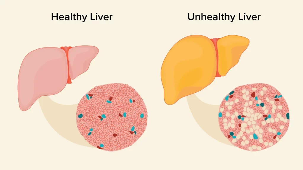 Alcohol's Impact on Liver